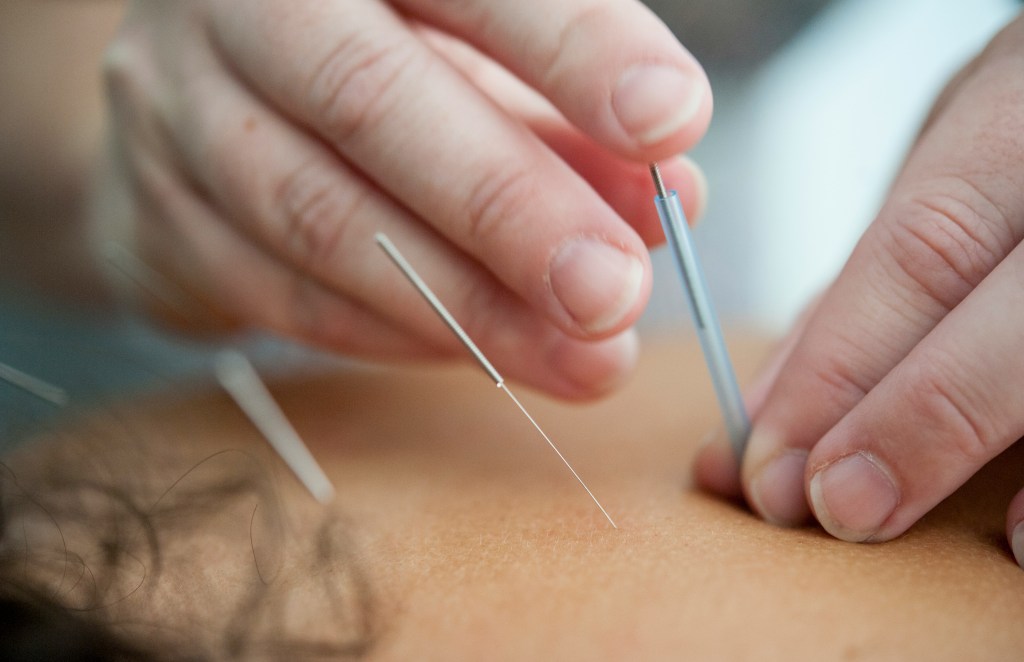 Facial Rejuvenation Acupuncture: A Holistic Approach to Radiant Skin